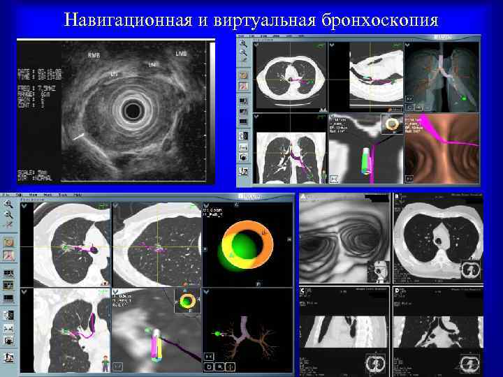 Навигационная и виртуальная бронхоскопия 56 