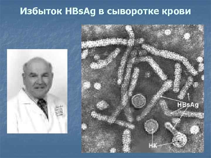 Избыток HBs. Ag в сыворотке крови 