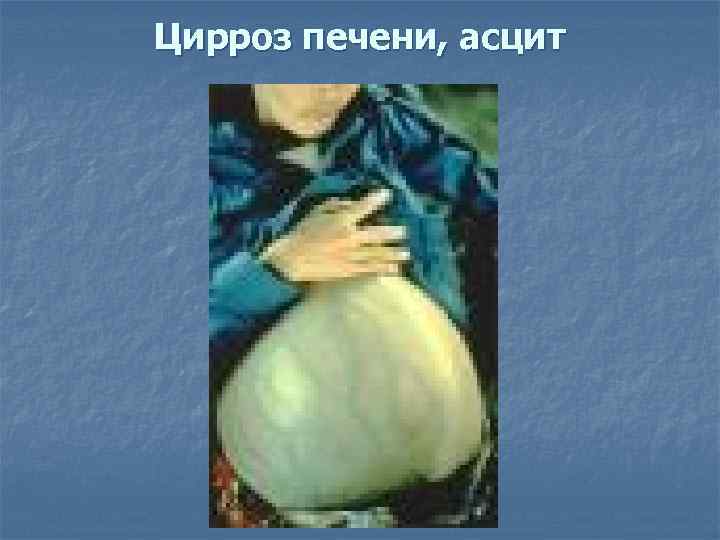 Цирроз печени, асцит 