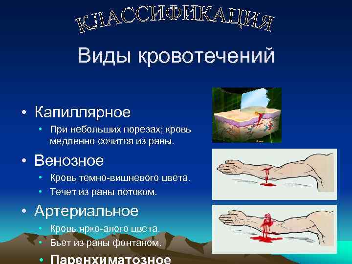    Виды кровотечений  • Капиллярное  • При небольших порезах; кровь