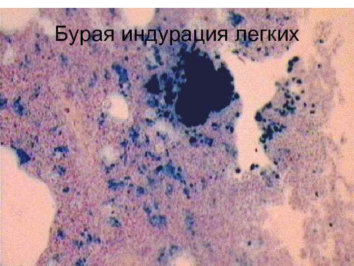Бурая индурация легких 