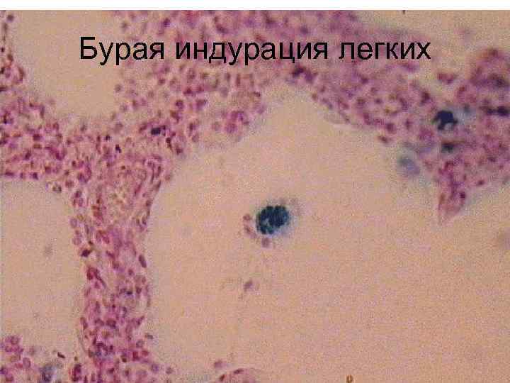 Бурая индурация легких 