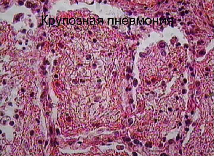 Крупозная пневмония 