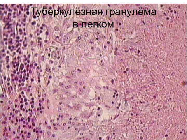 Туберкулёзная гранулёма   в легком 