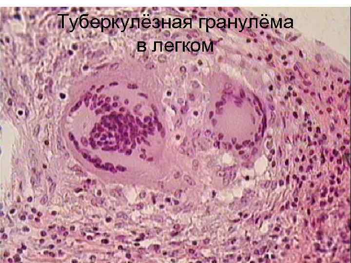 Туберкулёзная гранулёма   в легком 