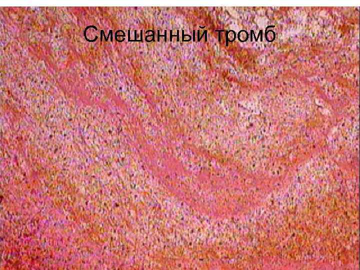 Смешанный тромб 