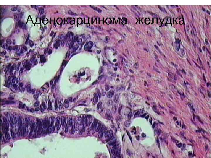 Аденокарцинома желудка 