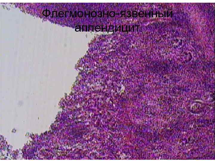 Флегмонозно-язвенный аппендицит 