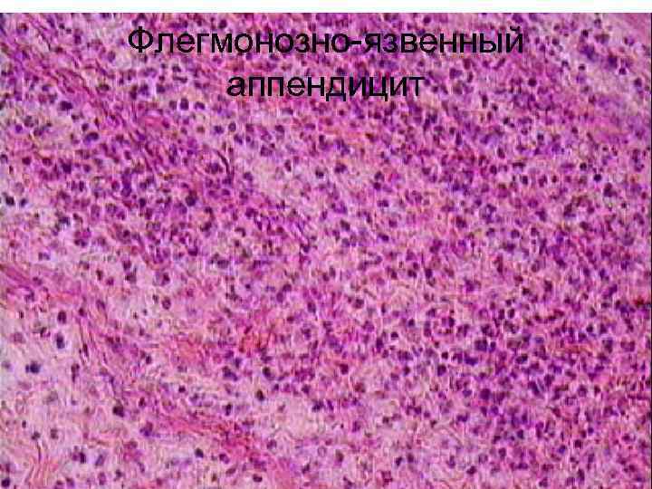 Флегмонозно-язвенный аппендицит 