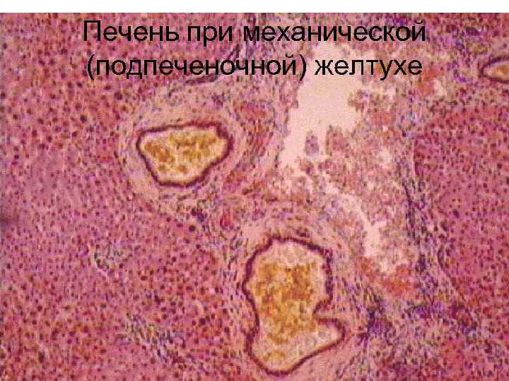 Печень при механической (подпеченочной) желтухе 
