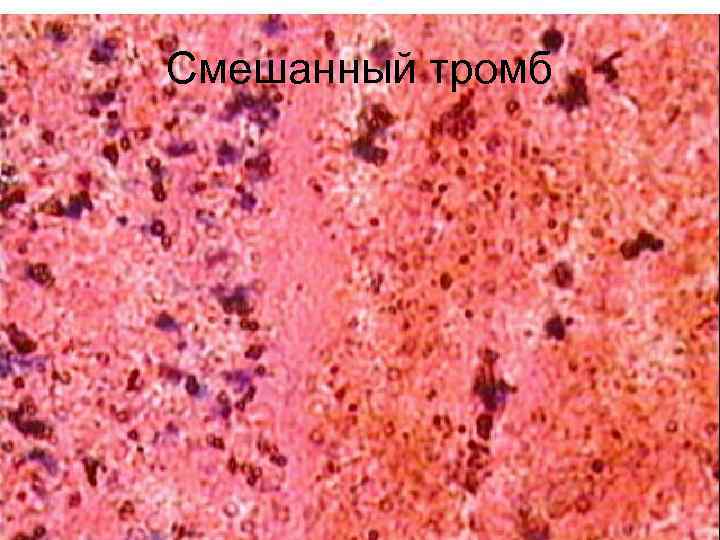 Смешанный тромб 