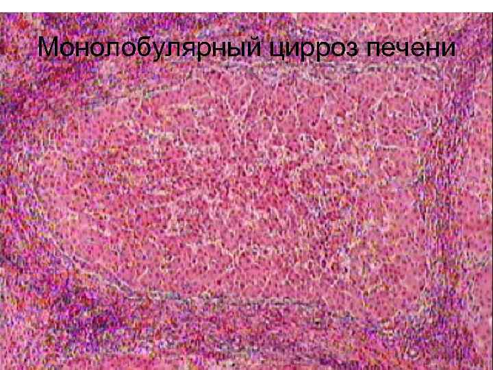 Монолобулярный цирроз печени 