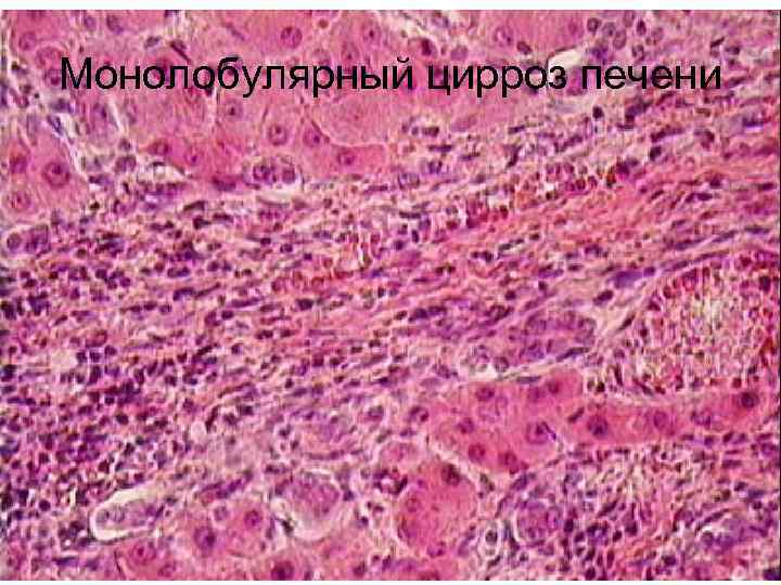 Монолобулярный цирроз печени 