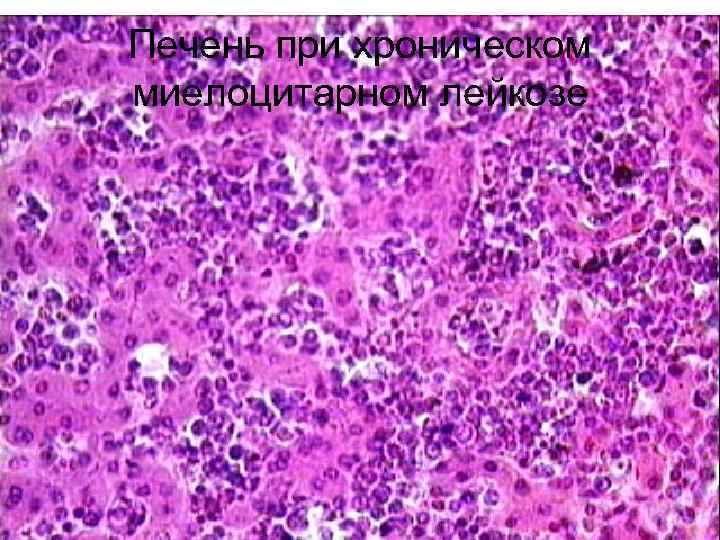 Печень при хроническом миелоцитарном лейкозе 