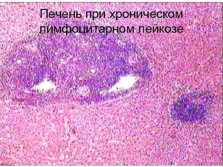 Печень при хроническом лимфоцитарном лейкозе 