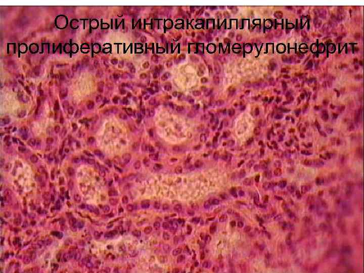   Острый интракапиллярный пролиферативный гломерулонефрит 