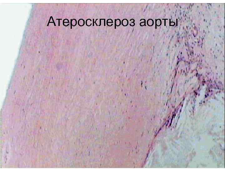 Атеросклероз аорты 