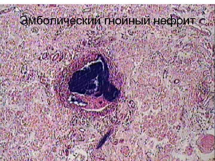 Эмболический гнойный нефрит 