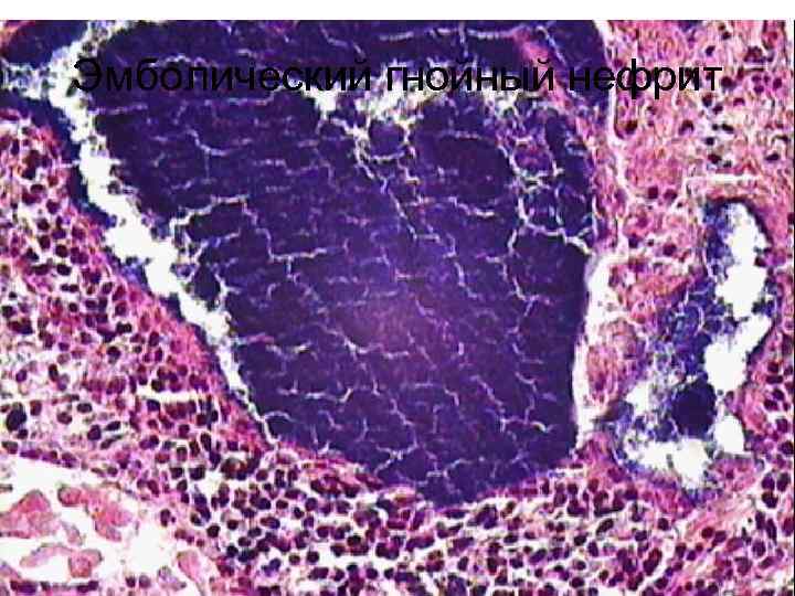 Эмболический гнойный нефрит 