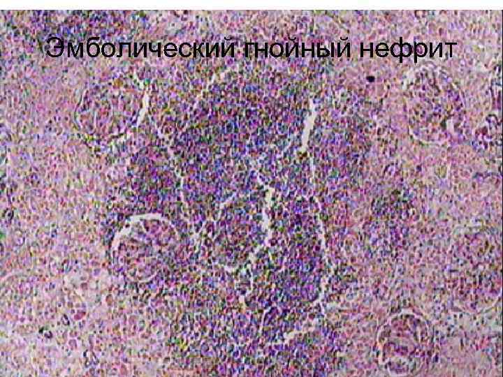 Эмболический гнойный нефрит 