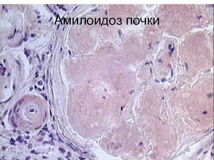 Амилоидоз почки 
