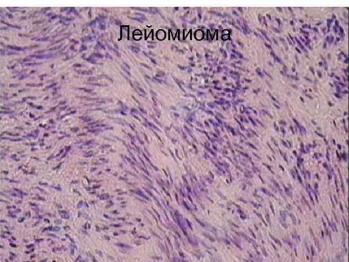 Лейомиома 