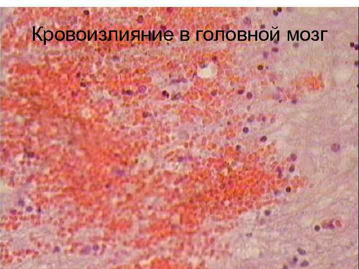 Кровоизлияние в головной мозг 