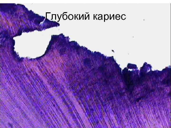 Глубокий кариес 