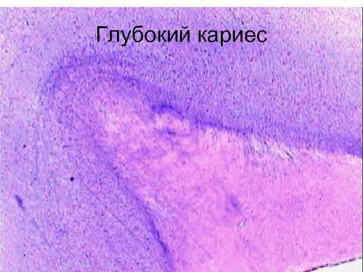 Глубокий кариес 