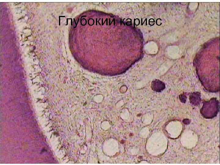 Глубокий кариес 