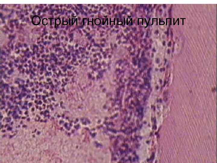 Острый гнойный пульпит 