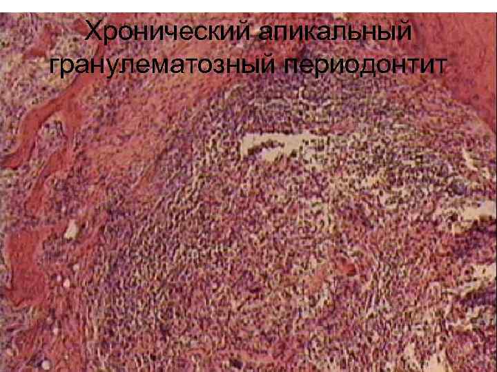   Хронический апикальный гранулематозный периодонтит 