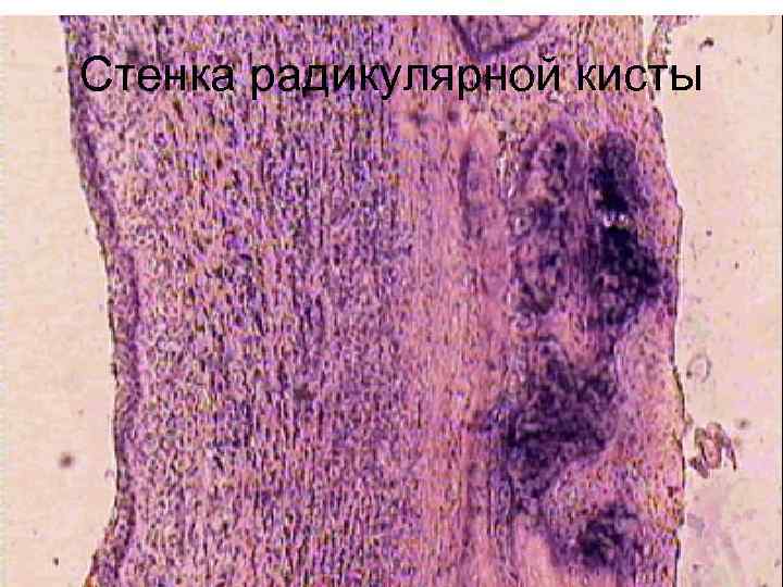 Стенка радикулярной кисты 