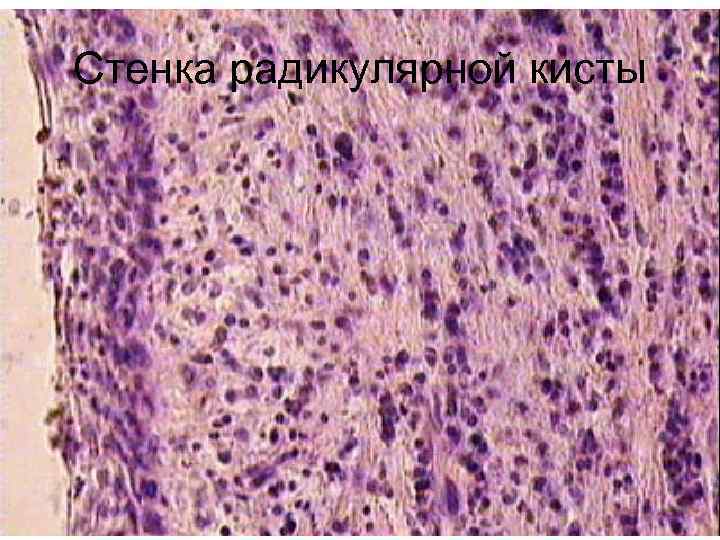 Стенка радикулярной кисты 