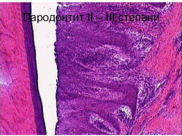 Пародонтит II – III степени 