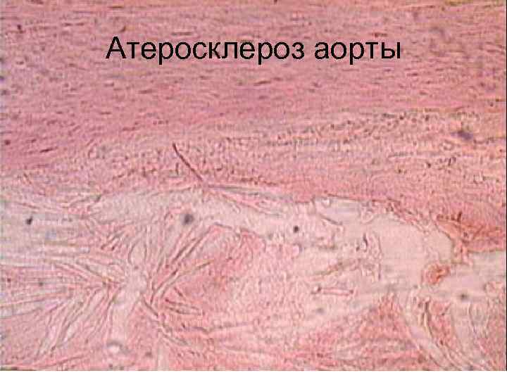 Тромб микропрепарат. Атеросклероз артерий гистология. Атеросклероз сосудов гистология. Препарат атеросклероз аорты патологическая анатомия. Атеросклероз аорты патанатомия.