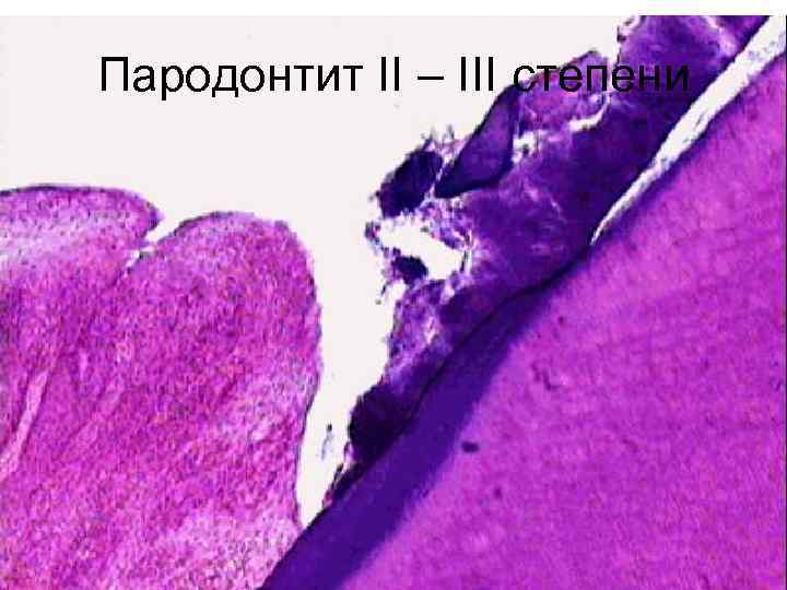 Пародонтит II – III степени 