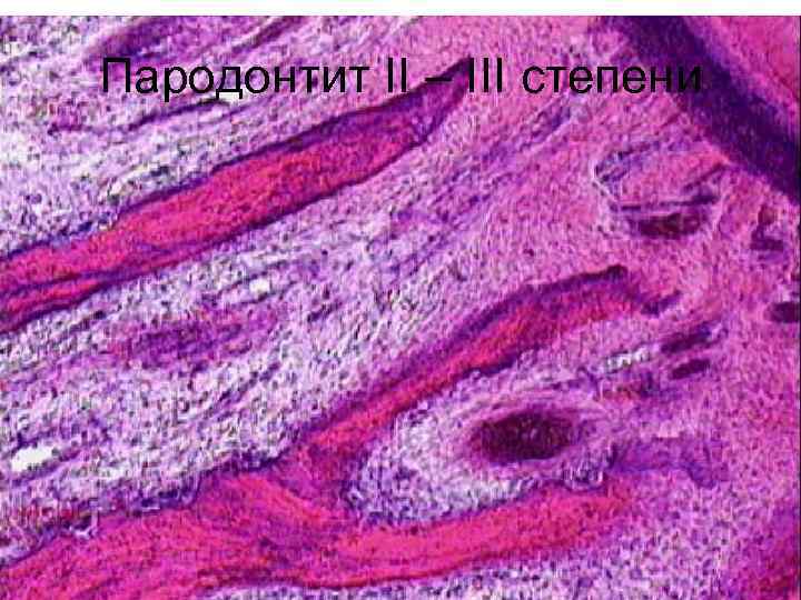 Пародонтит II – III степени 