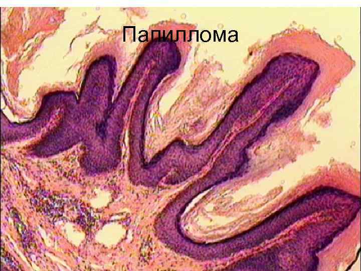 Смешанный тромб. Смешанный тромб с началом организации микропрепарат. Смешанный тромб внешний вид. Смешанный тромб на шее.