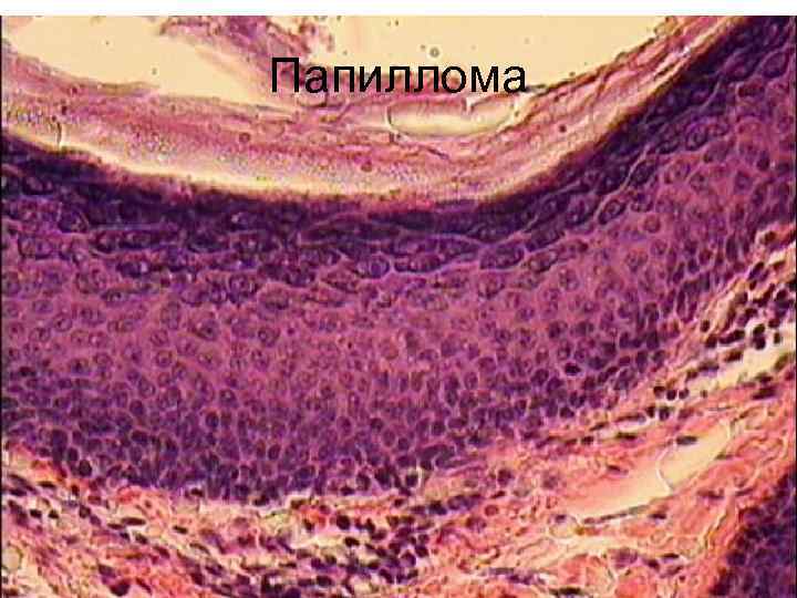 Папиллома 