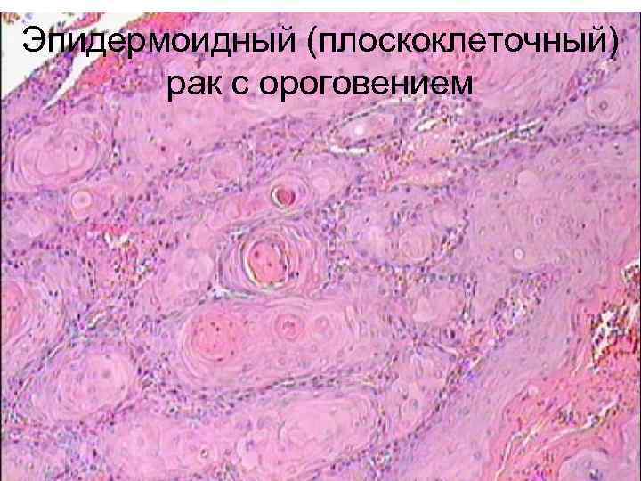 Эпидермоидный (плоскоклеточный)  рак с ороговением 