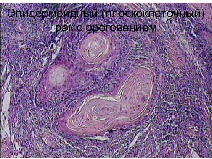 Эпидермоидный (плоскоклеточный)  рак с ороговением 
