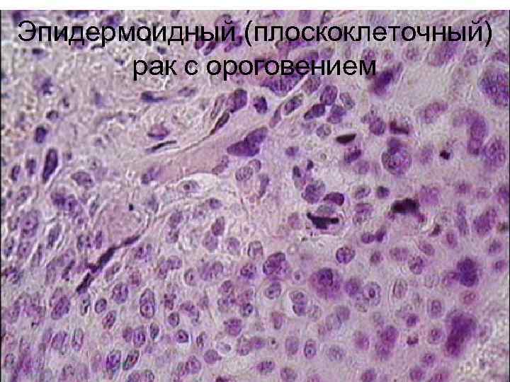 Эпидермоидный (плоскоклеточный)  рак с ороговением 