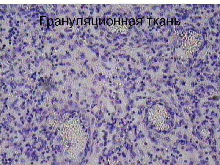 Грануляционная ткань 