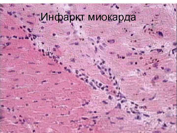 Инфаркт миокарда 