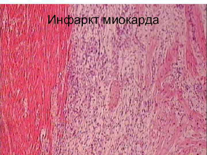 Инфаркт миокарда 
