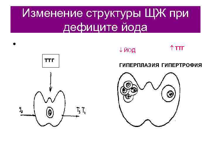   Изменение структуры ЩЖ при  дефиците йода •    