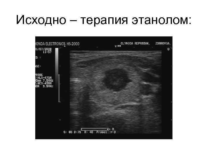 Исходно – терапия этанолом: 