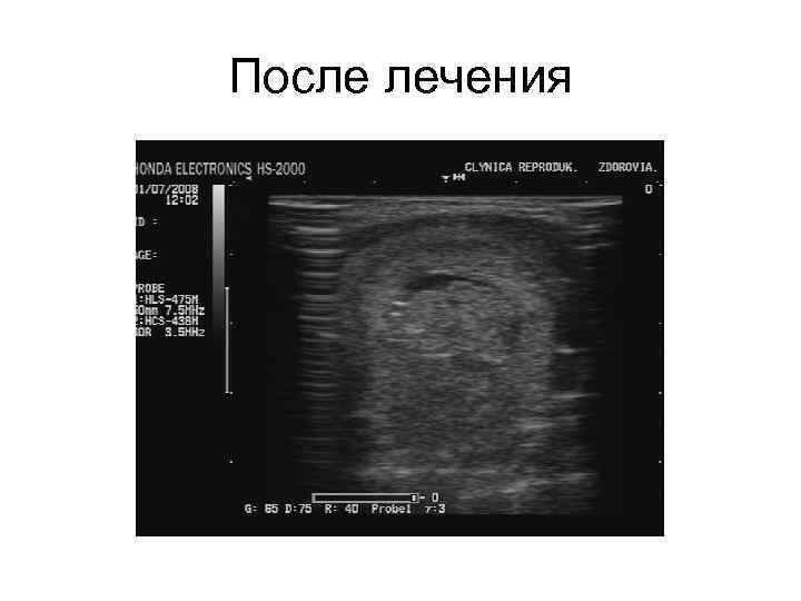 После лечения 