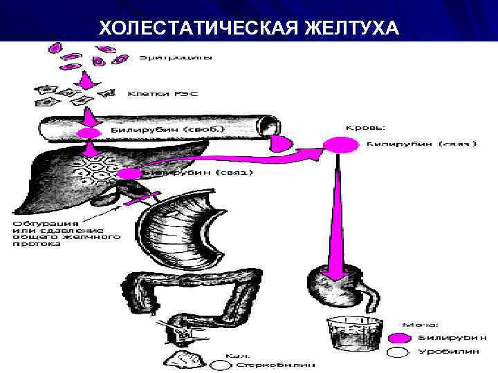 ХОЛЕСТАТИЧЕСКАЯ ЖЕЛТУХА 